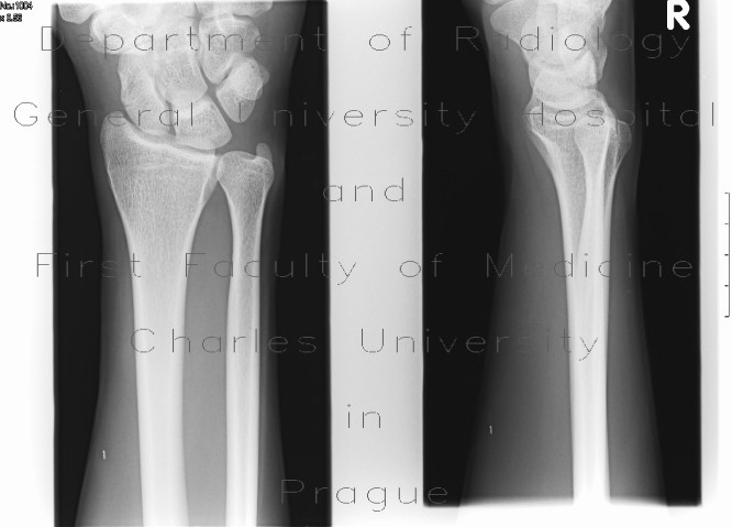 Radiology image - Fracture of navicular bone: Extremity, Bone: X-ray - Plain radiograph