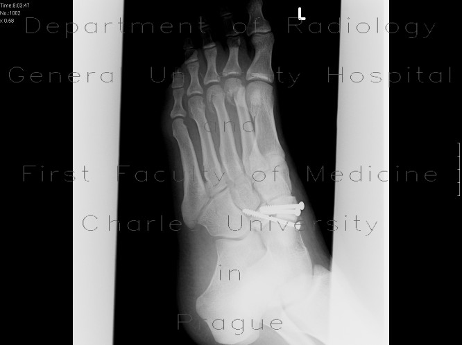 Fracture of navicular bone and metatarsal bones