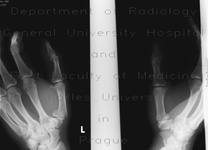 Fracture of navicular bone, fracture of first metacarpal bone