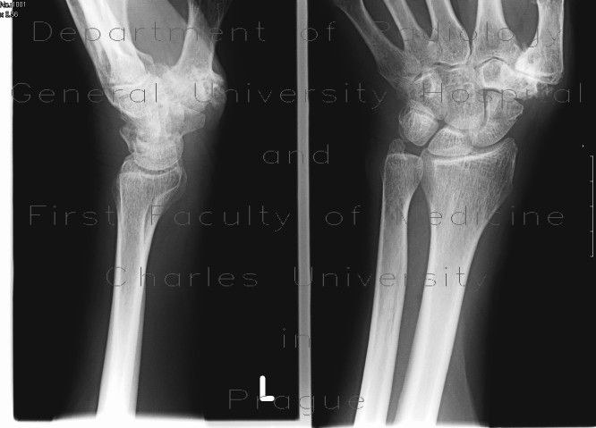 Fracture of navicular bone, rhizarthrosis