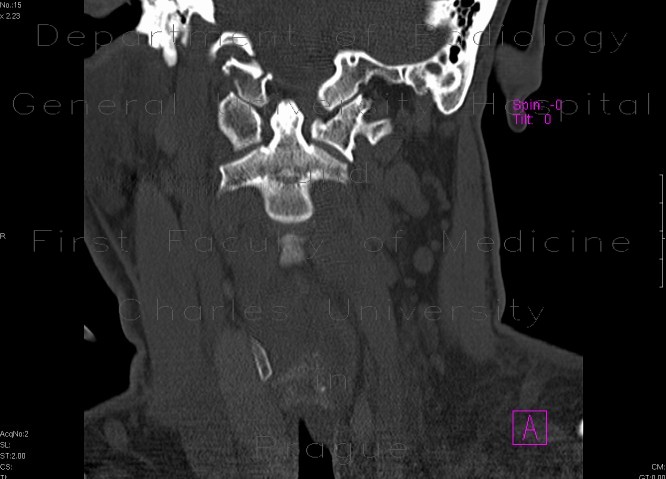 Radiology image - Fracture of occipital condyle: Spine and Axial, Bone: CT - Computed tomography