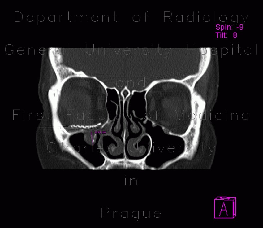 Fracture of orbital floor