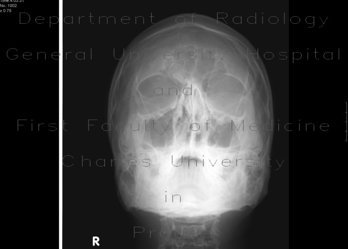 Fracture of orbital floor, tear-drop figure, hemosinus