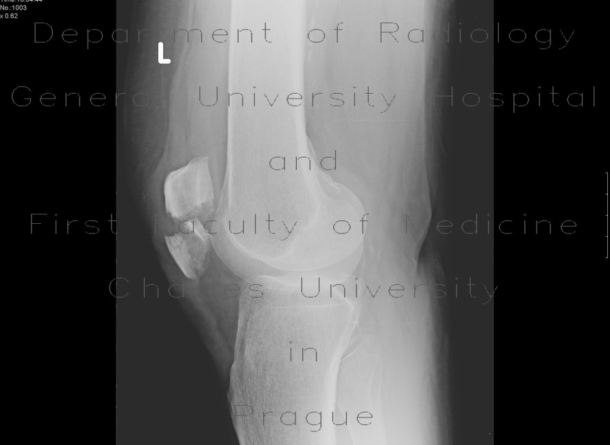 Fracture of patella