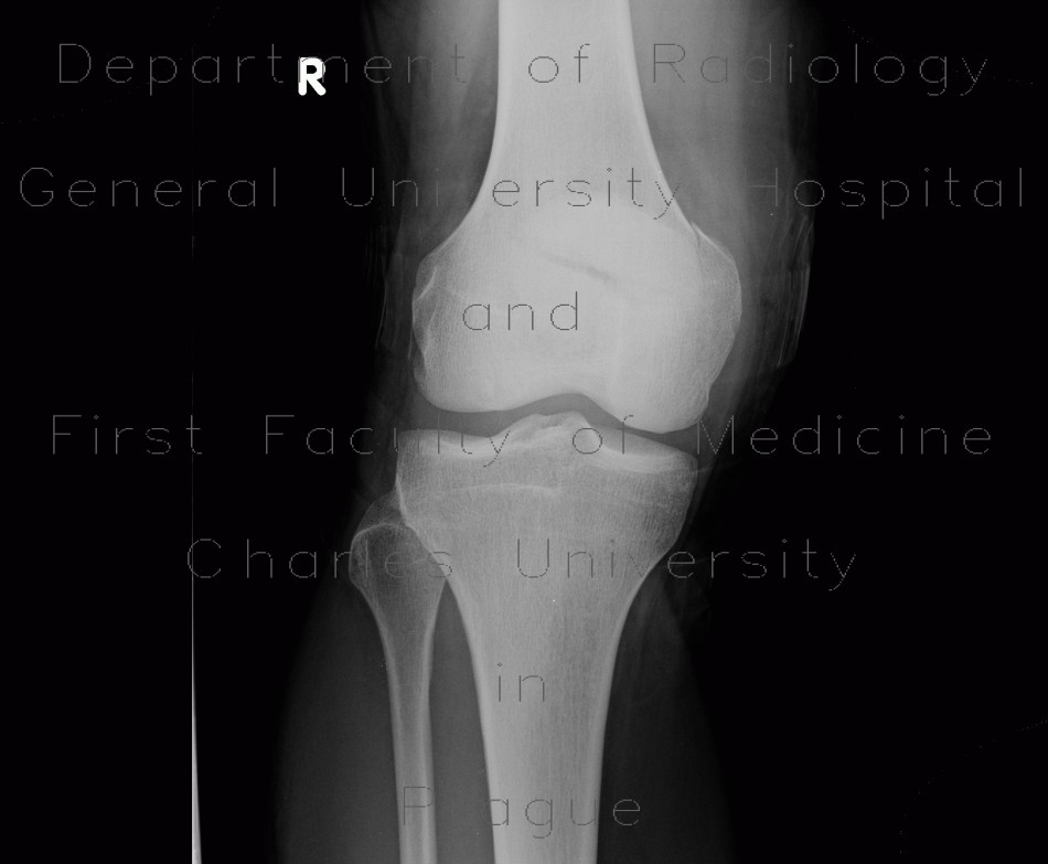 Radiology image - Fracture of patella: Extremity, Bone: X-ray - Plain radiograph