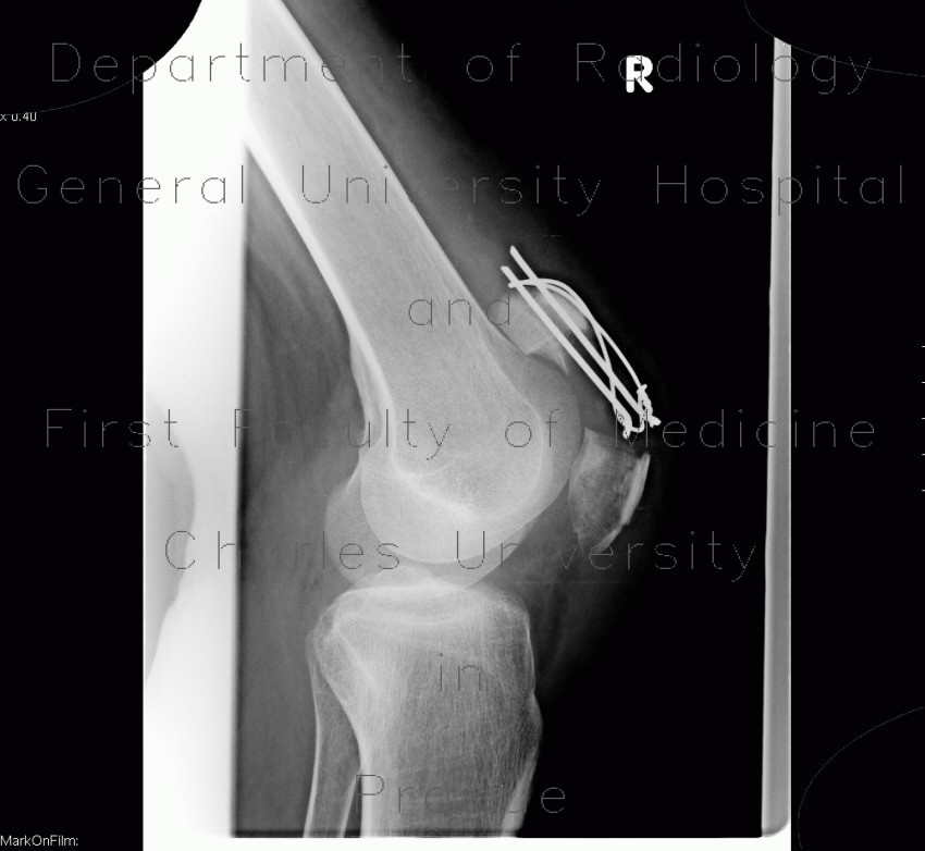 Radiology image - Fracture of patella, hardware failure: Extremity, Bone: X-ray - Plain radiograph