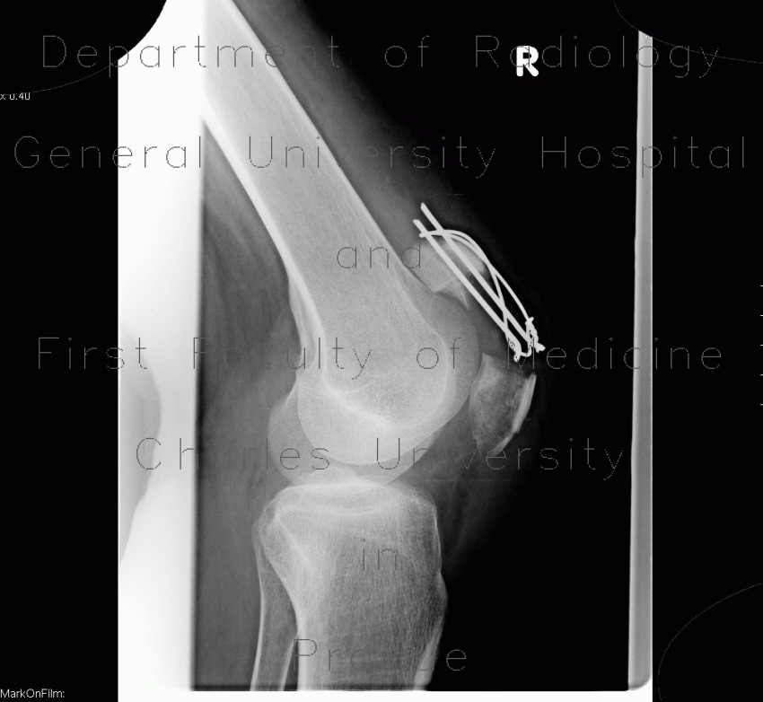 Fracture of patella, hardware failure