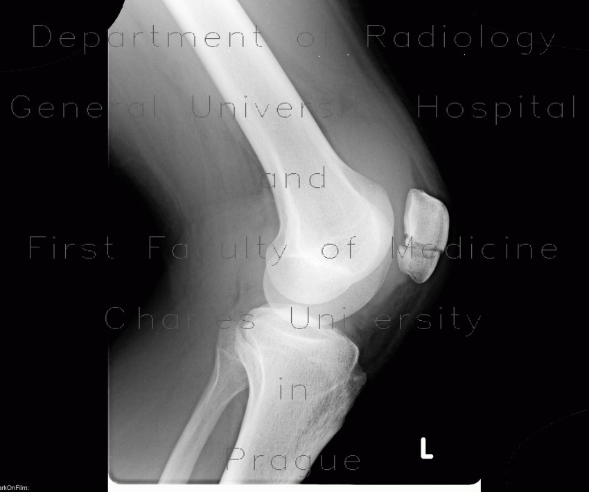 Fracture of patella, hematoma in suprapatellar recess