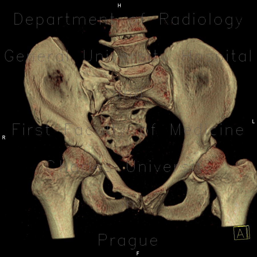 Radiology image - Fracture of pelvis, pubic bone, subluxation of sacrum, VRT: Spine and Axial, Bone: CT - Computed tomography