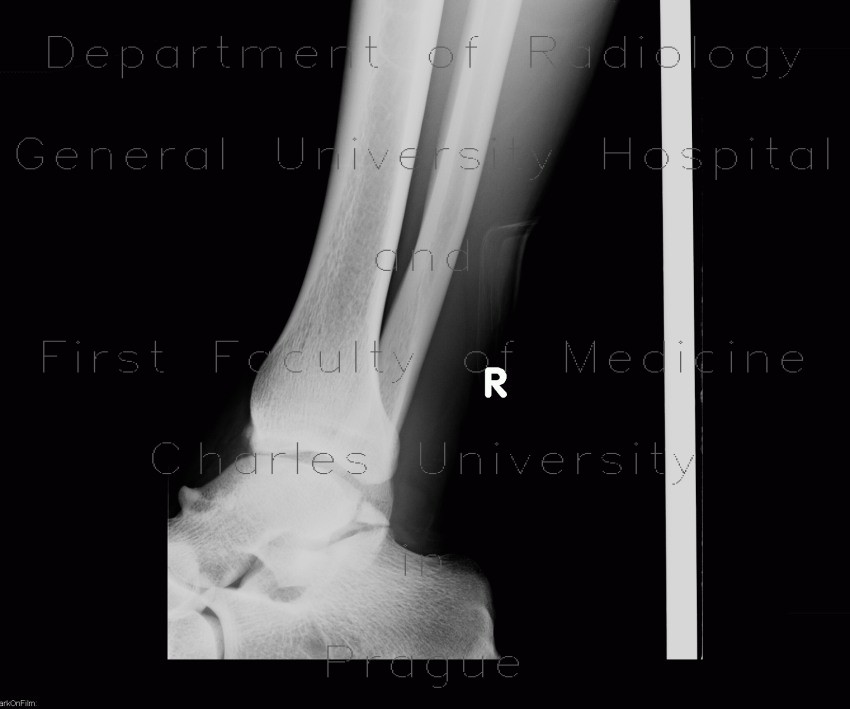 Fracture of processus posterior tali