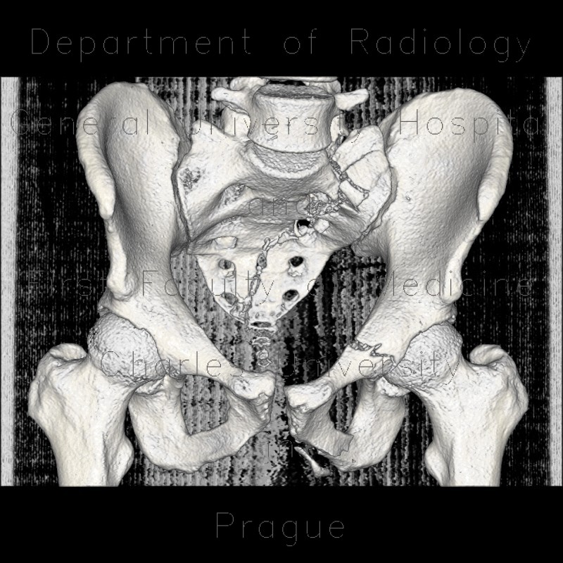 Fracture of pubic bone and sacrum, SSD