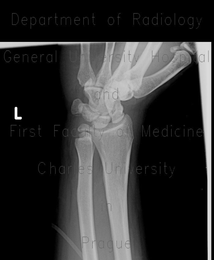 Fracture of scaphoid bone, dislocation of pisiform bone, abruption of lunate