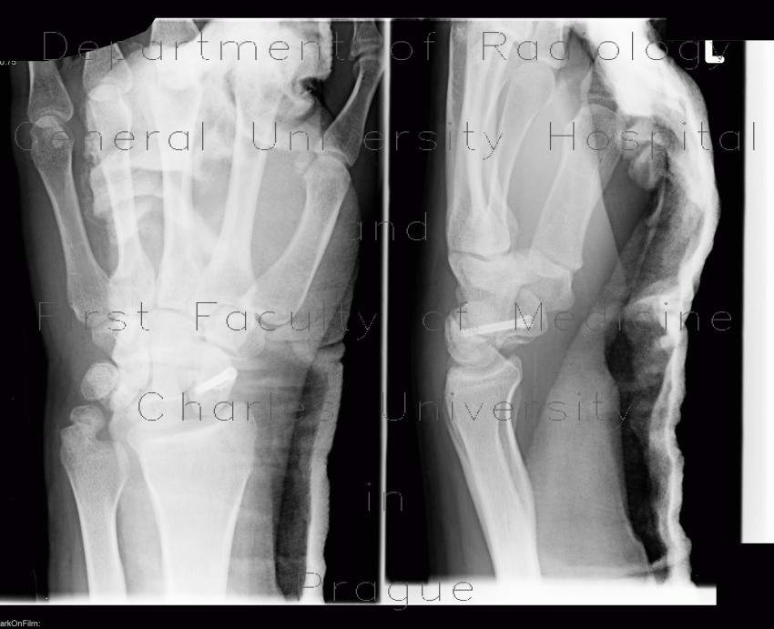 Fracture of scaphoid bone, perilunar subluxation