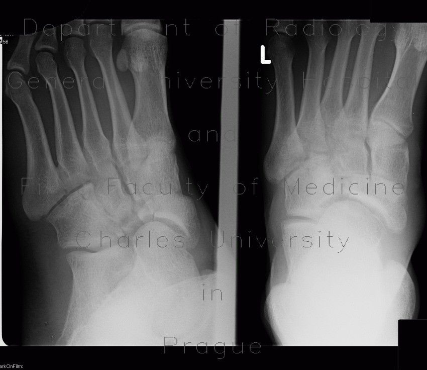 Fracture of tarsal bones