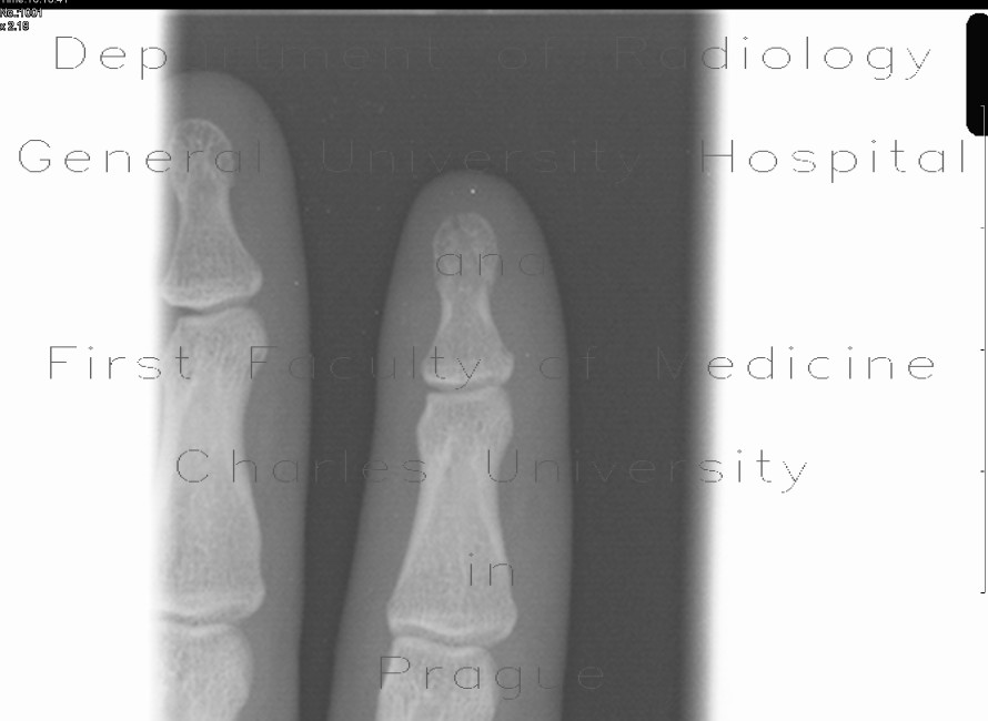 Radiology image - Fracture of the distal phalangeal tuberosity: Extremity, Bone: X-ray - Plain radiograph