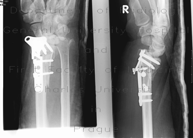Radiology image - Fracture of the distal radius, fracture of compression plate: Extremity, Bone: X-ray - Plain radiograph