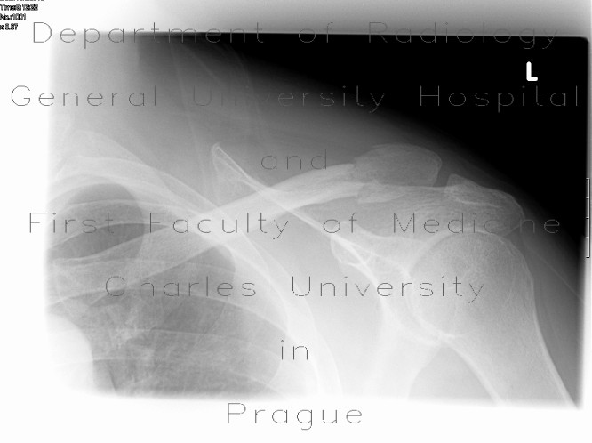 Fracture of the lateral end of the collar bone (clavicle)