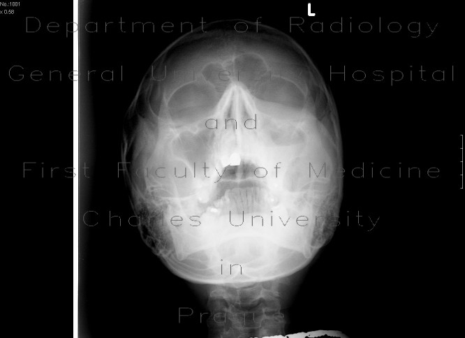 Fracture of the left zygomaticomaxillary complex (ZMK), hemosinus