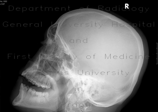 Fracture of the mandible
