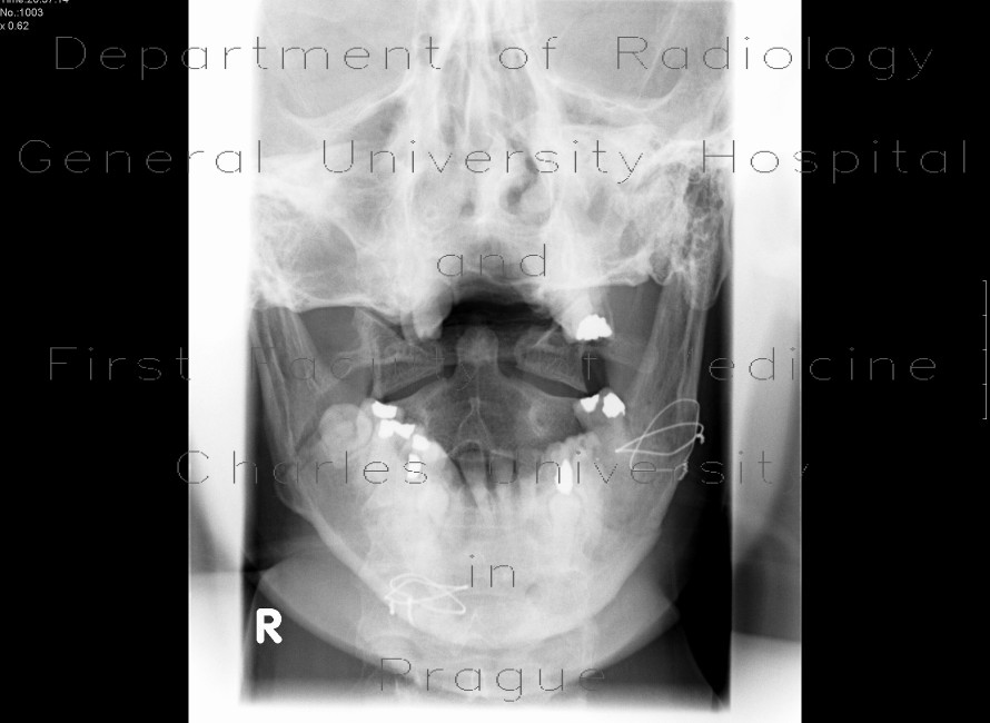 Fracture of the mandible