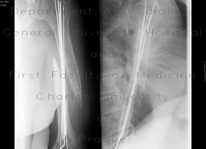 Radiology image - Fracture of the shaft of humerus, osteosynthesis with K wires: Extremity, Bone: X-ray - Plain radiograph