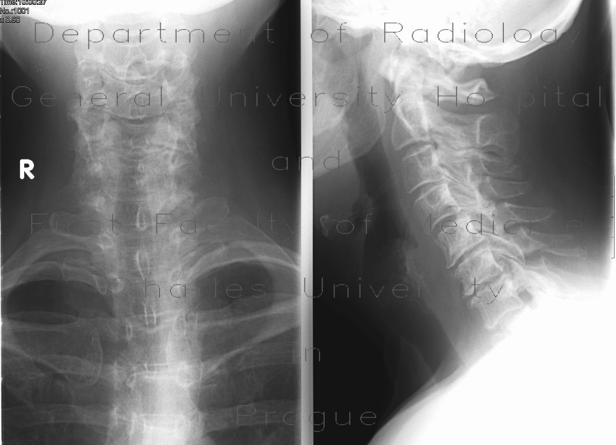 Radiology image - Fracture of the spinous process C6 - Clay shoveler