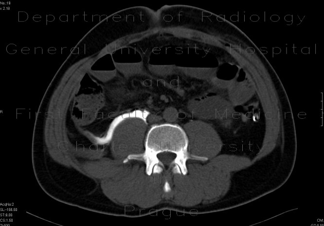 Radiology image - Fracture of the transverse process of lumbar vertebra: Spine and Axial, Bone: CT - Computed tomography
