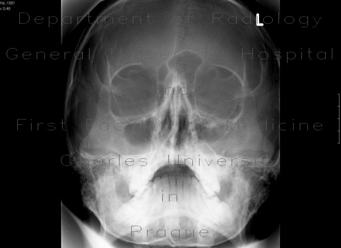 Radiology image - Fracture of the zygomatico-maxillary complex, left side, hemosinus: Head and Neck, Bone, Sinuses: X-ray - Plain radiograph
