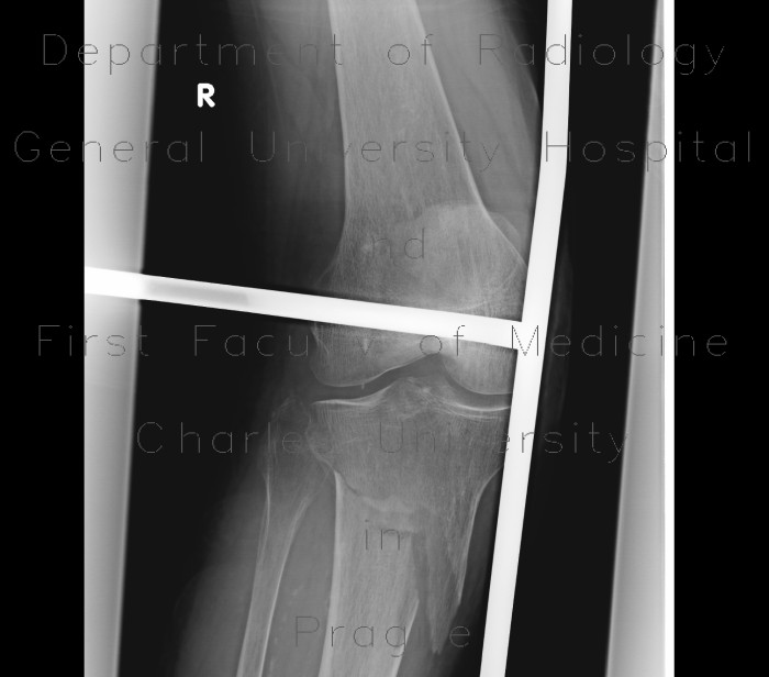 Radiology image - Fracture of tibia: Extremity, Bone: X-ray - Plain radiograph