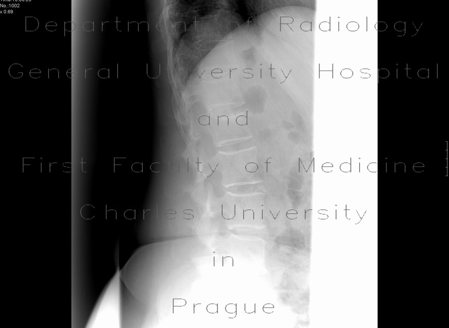 Radiology image - Fracture of vertebra L1: Spine and Axial, Bone: X-ray - Plain radiograph