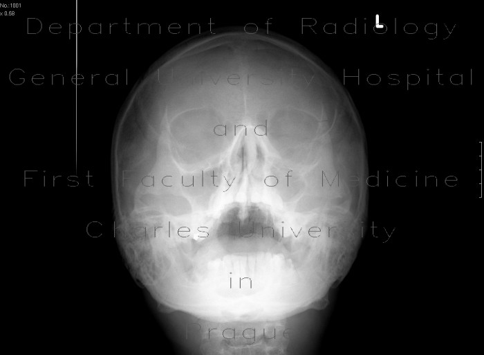 Fracture of zygomaticomaxillary complex, ZMK