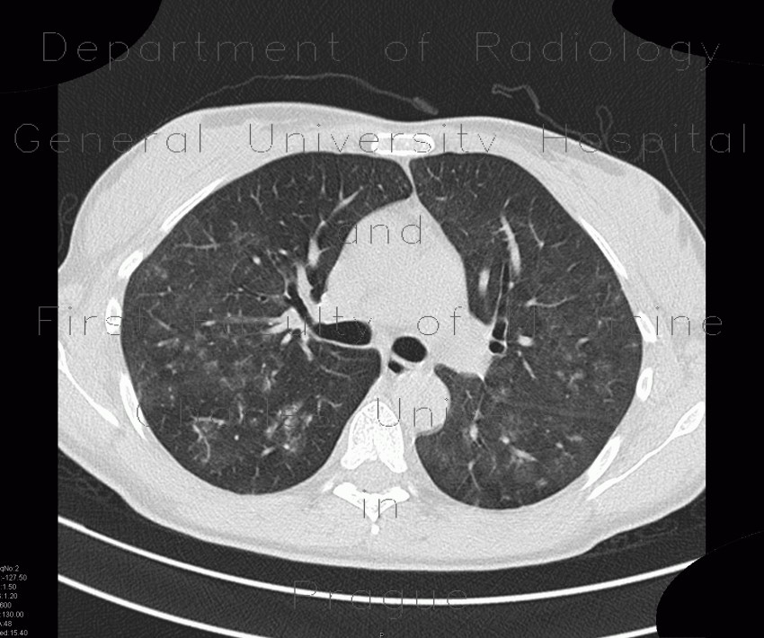 Fungal infection of lung, mycosis