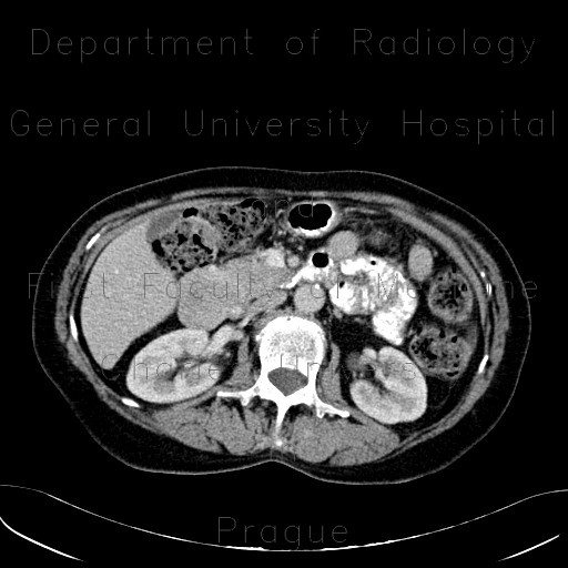 Radiology image - GIST of duodenum, gastrointestinal stromal tumour: Abdomen, Small bowel: CT - Computed tomography
