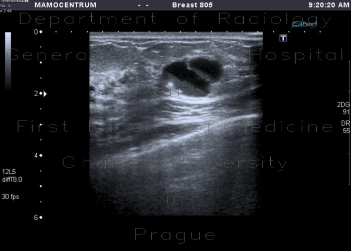 Radiology image - Galactocoele: Thorax, Breast: US - Ultrasound