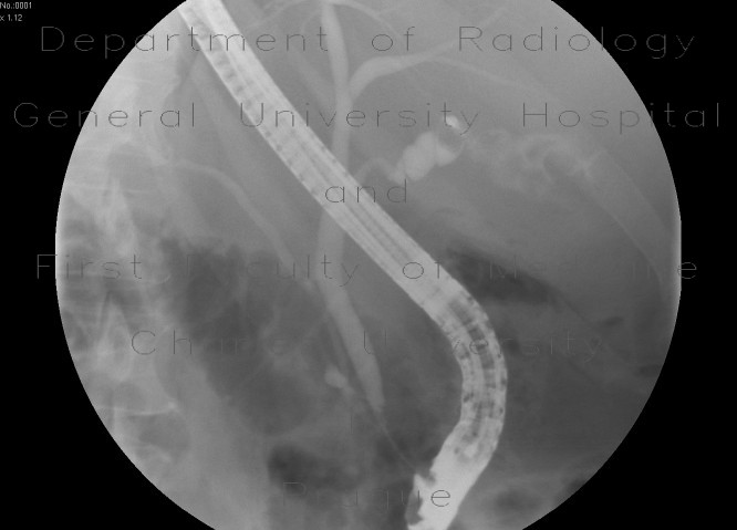 Radiology image - Gallbladder stones, multiple, cholecystolithiasis: Abdomen, Biliary tree: RF - Fluoroscopy