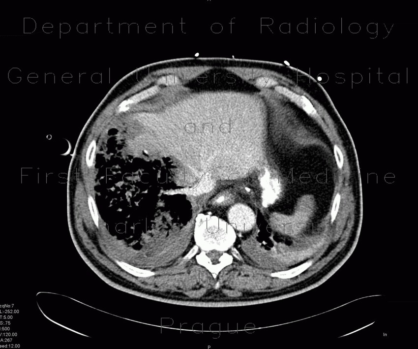 Radiology image - Gangrene of the liver: Abdomen, Liver: CT - Computed tomography