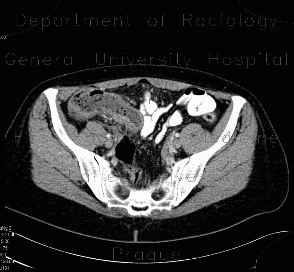 Gangrenous appendicitis