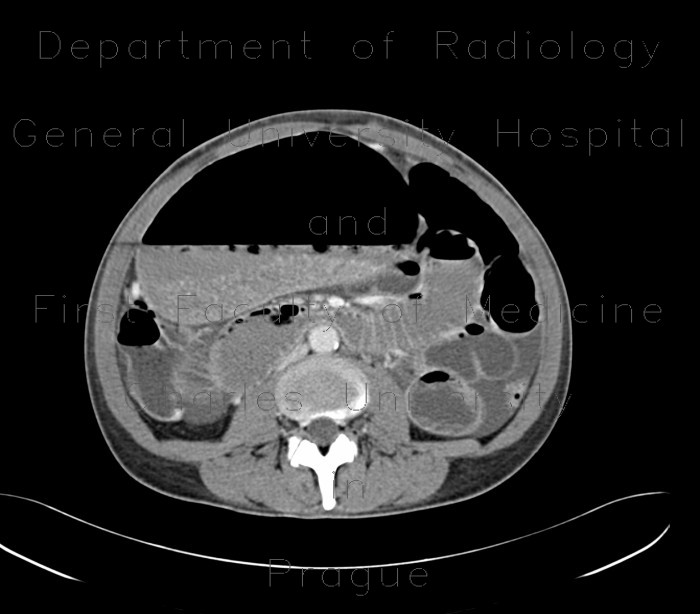 Radiology image - Gastrectasia, distension of stomach, ileus: Abdomen, Small bowel, Stomach: CT - Computed tomography