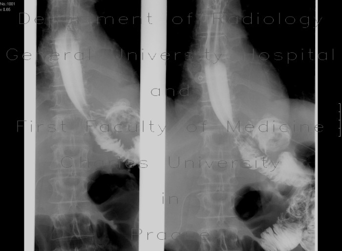 Radiology image - Gastrectomy, esophago-entero-anastomosis: Abdomen, Oesophagus, Small bowel, Stomach: RF - Fluoroscopy