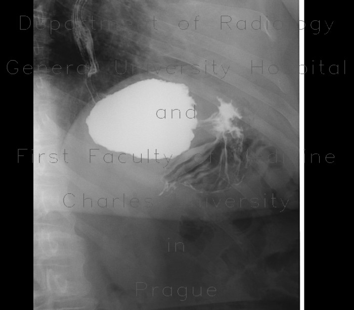 Radiology image - Gastric banding: Abdomen, Stomach: RF - Fluoroscopy