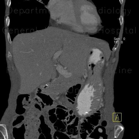 Gastric folds, prominent