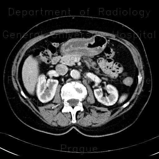 Gastritis, acute, antral