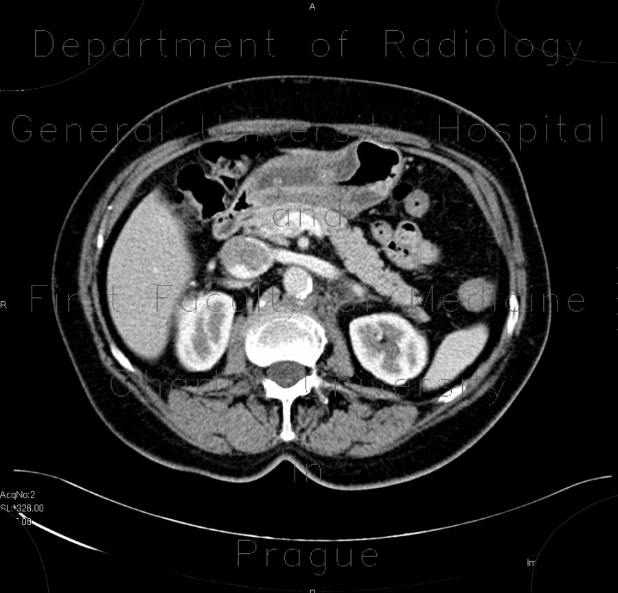 Radiology image - Gastritis, acute, antral: Abdomen, Stomach: CT - Computed tomography