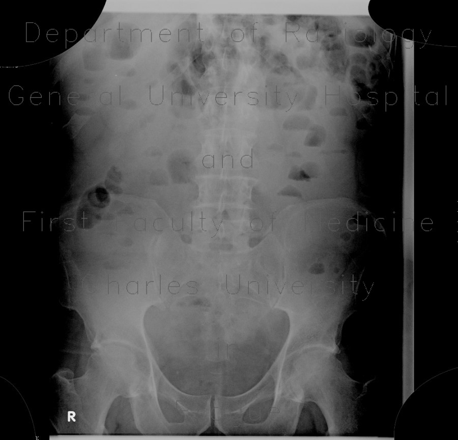 Radiology image - Gastroenteritis, acute, diarrhea: Abdomen, Large bowel, Small bowel: X-ray - Plain radiograph