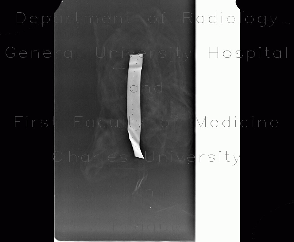 Gauze, radioopaque stripe