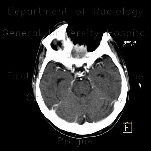 Radiology image - Gigantic defect in face after resection of carcinoma: Head and Neck, Orbit, Sinuses: CT - Computed tomography