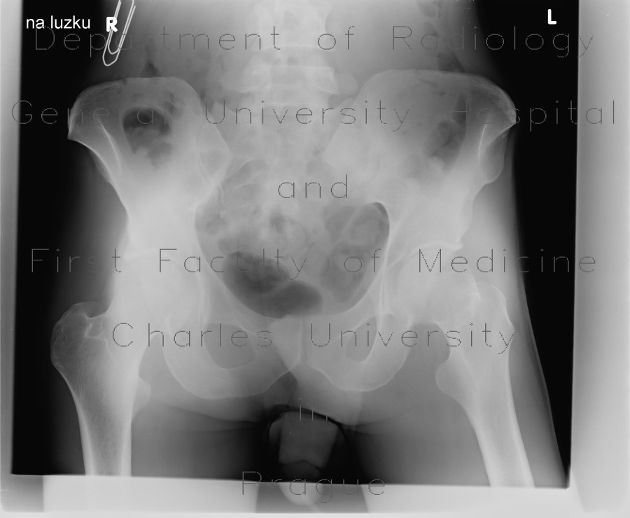 Gluteus minimus, gluteus medius, shadow of muscle