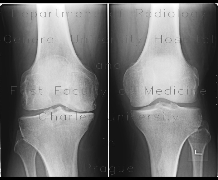 Radiology image - Gonarthrosis: Extremity, Bone: X-ray - Plain radiograph