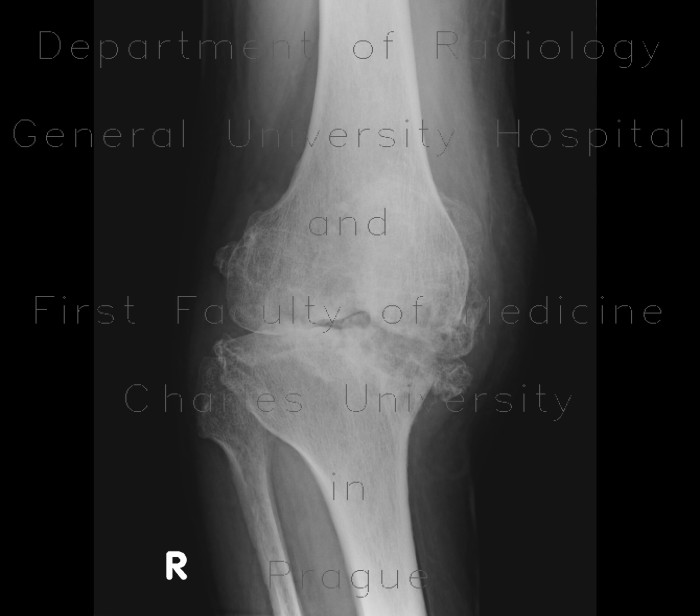 Radiology image - Gonarthrosis, severe: Extremity, Bone: X-ray - Plain radiograph