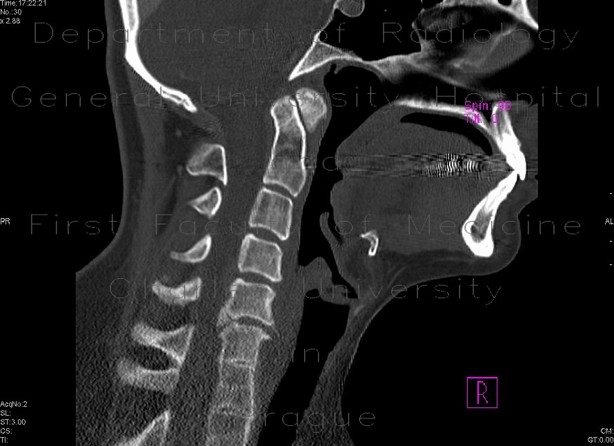 Radiology image - Gorlin Goltz Syndrom: Head and Neck, Spine and Axial, Bone, Brain: CT - Computed tomography